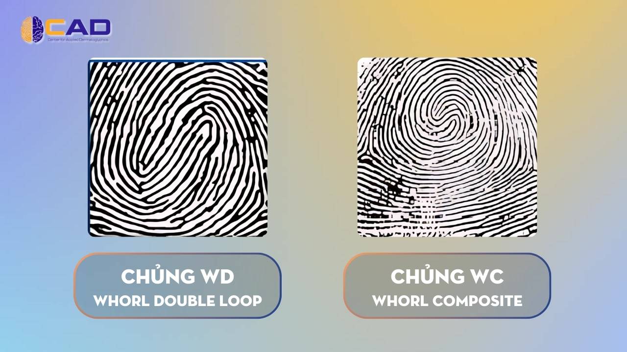 Đặc điểm nhận diện Chủng WD & chủng WC - Whorl Double Loop - Whorl Composite